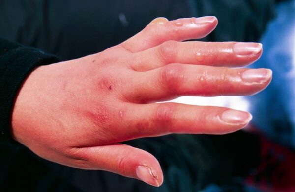 Береги себя от холода: всё об обморожении